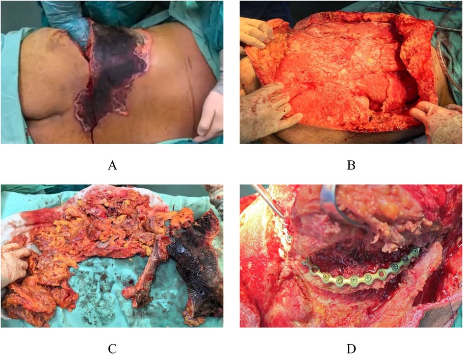 A patient undergoing surgical treatment for necrotizing fasciitis on the chest and abdomen. Image A shows an area of necrotic tissue on the patient's torso. Image B displays the lifted skin to reveal underlying tissue. Image C shows excised necrotic tissue on a surgical drape. Image D depicts surgical reconstruction with visible metal hardware securing repaired tissue.