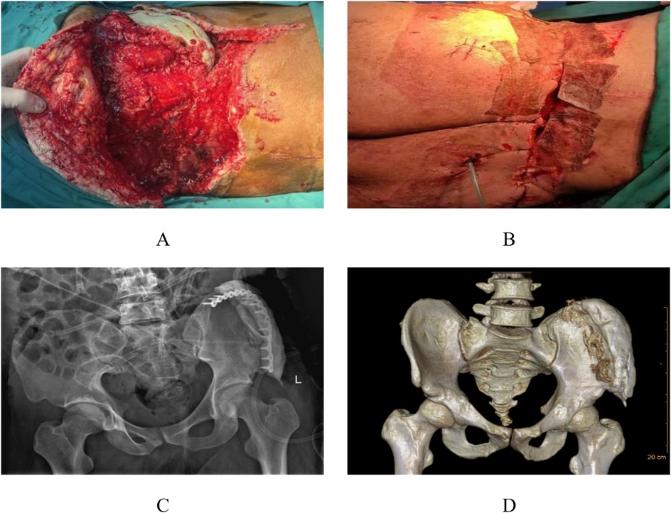 Panel A shows a surgical wound on the hip with exposed tissue and muscle. Panel B depicts the same area with stitches and dressing. Panel C displays an X-ray of the pelvic region. Panel D illustrates a 3D reconstruction of the pelvis from CT imaging, highlighting bone structures.