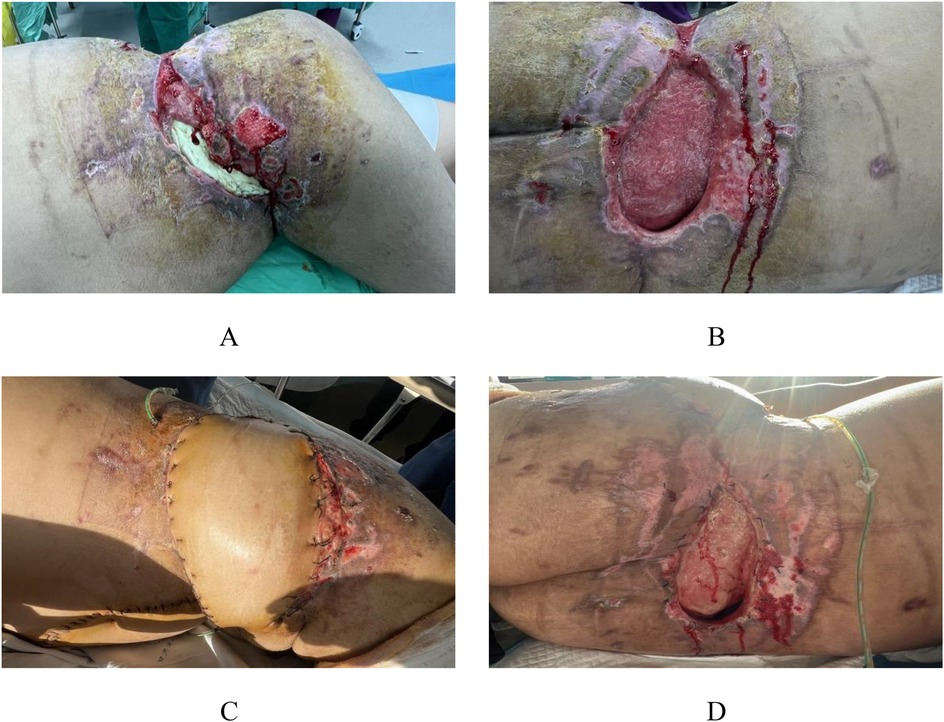 Images showing different stages of an infected wound on a human body. Panel A displays a severe wound with visible necrosis and pus. Panel B shows the wound cleaned with exposed tissue. Panel C depicts the wound after surgical closure with stitches in place. Panel D shows a reopened area with inflamed tissue and drainage.