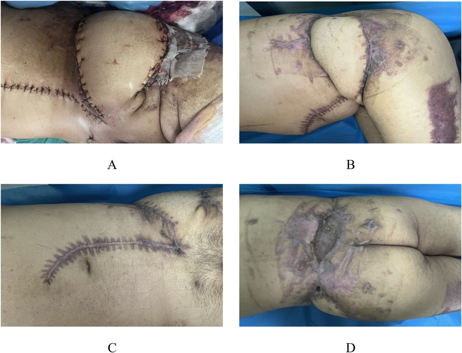 Four-panel image showing surgical procedures and healing on a person's hip and upper thigh. Panel A: Fresh surgical stitches on the hip. Panel B: Healing scars on the upper thigh. Panel C: Curved surgical scar on the hip. Panel D: Scar tissue and healing on the buttocks.