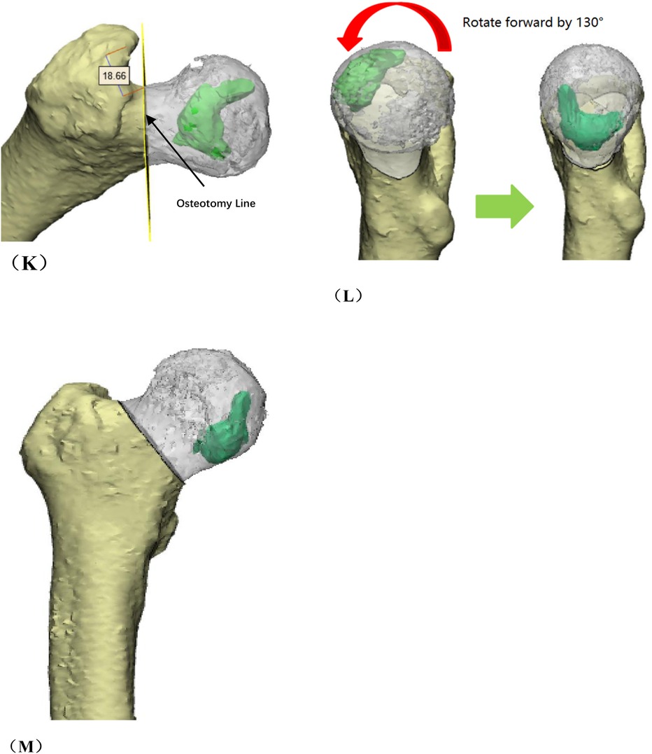 A set of radiological images of the hip joint. Panel A is an X-ray showing femoral neck, head, and greater trochanter marked. Panel B is an X-ray highlighting the lesser trochanter. Panel C is a CT sagittal view indicating a necrotic area in the femoral head. Panel D is an axial CT scan of the pelvis. Panels E and F are MRI scans of the hips in coronal view, showing detailed soft tissue and bone structures, with abnormalities visible in the femoral heads. Panel G shows a 3D reconstruction of the pelvis and femurs with the right femur in yellow and the left femur in blue. Panel H is a CT slice illustrating the Kerboul angle measurement of a necrotic area in the femoral head (95.07\xB0). Panel I is a 3D femoral model marking the greater trochanter, femoral head, femoral neck, and lesser trochanter, with a necrotic area highlighted in green and an angle measurement of 48.71\xB0. Panel J presents another 3D view of the femoral head with the necrotic area shaded in green, showing a measured value of 19.02\xB0. Panel K shows a 3D femoral reconstruction with an osteotomy line marked and a measured angle of 18.66\xB0, with the necrotic area highlighted in green. Panel L illustrates a surgical simulation where the femoral head is rotated forward by 130\xB0 to reposition the necrotic area. Panel M shows the post-rotation 3D model of the femoral head with the necrotic region now located differently on the surface.