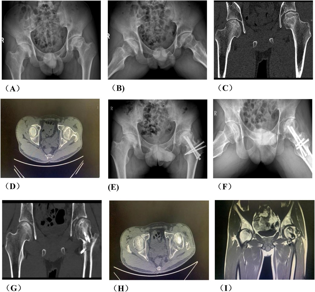 A series of medical imaging scans showing different perspectives and conditions of a pelvis. Images A, B, and F are X-rays of the pelvis with various angles; C and G are coronal CT scans; D and H are axial CT scans highlighting the pelvis structure; E and F exhibit post-operative conditions with metal surgical fixations; I is an MRI scan of the pelvis detailing soft tissue and bone structures.