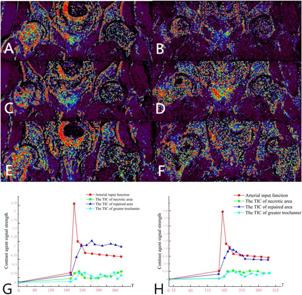 MRI images labeled A to F show color-coded areas of hip joints, highlighting different regions. Graphs G and H illustrate trends in contrast agent signal strength over time for arterial input, necrotic area, repaired area, and greater trochanter, using distinct colored lines for each parameter.