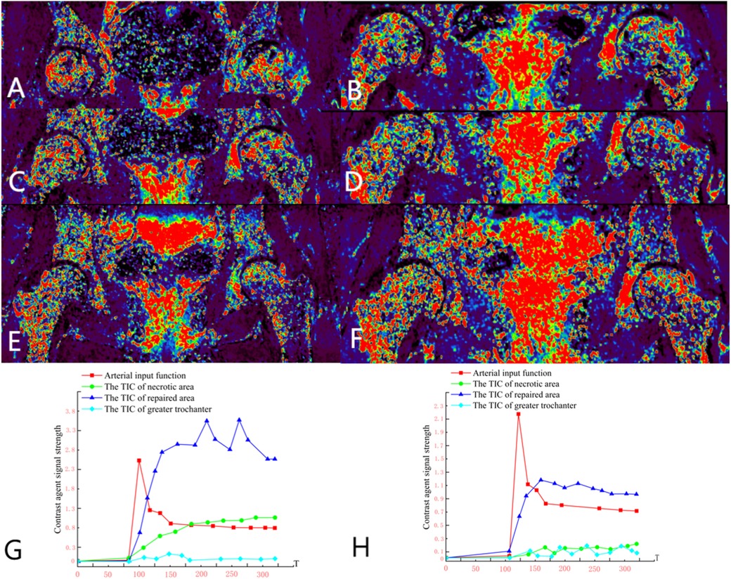Six color-coded medical images labeled A to F show variations in tissue intensity, focusing on the hip area. Below, graphs G and H display contrast agent signal strengths over time for different regions: arterial input, necrotic area, repaired area, and greater trochanter.