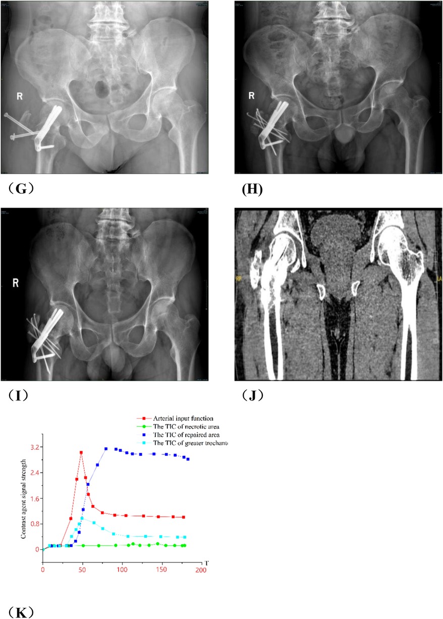 Panel A shows a frontal pelvic X-ray indicating a right-sided acetabular fracture. Panel B presents another radiograph with different positioning to further visualize the right acetabulum. Panel C is a coronal CT scan highlighting fracture lines in the right acetabulum and surrounding bony structures. Panel D shows a coronal T1-weighted MRI depicting joint space and soft tissue detail in the hip region. Panel E displays a coronal T2-weighted MRI with contrast enhancing fluid and inflammation near the right acetabulum. Panel F is a postoperative X-ray demonstrating internal fixation with multiple screws in the right acetabulum. Panel G shows a postoperative pelvic X-ray with internal fixation hardware in the right acetabulum, demonstrating early healing. Panel H displays a follow-up radiograph indicating stable fixation without signs of displacement. Panel I presents a later-stage X-ray confirming maintained alignment and bone remodeling. Panel J is a coronal CT image highlighting the right acetabular region with clear bone integration around the hardware. Panel K is a contrast-enhanced signal intensity graph showing time-intensity curves (TIC) for arterial input, necrotic area, repaired area, and greater trochanter, illustrating differential vascular response and tissue perfusion.