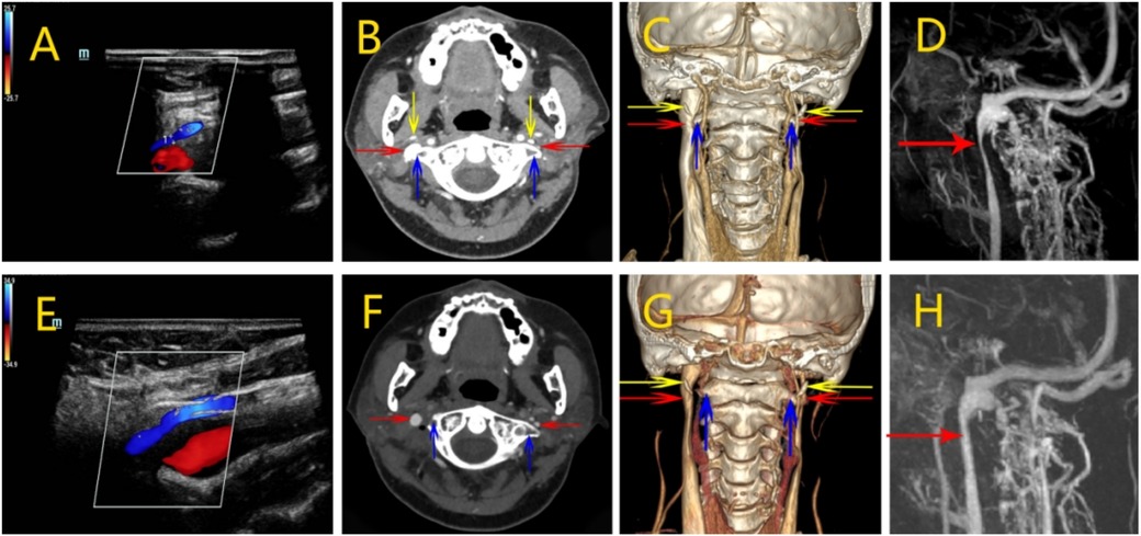 Medical imaging series showing various views of the neck. Images A and E depict ultrasound results with color Doppler showing blood flow. Images B and F show CT scans with arrows indicating specific structures. Images C and G provide 3D-rendered anatomical views of the neck with colored arrows for details. Images D and H are angiograms with an arrow pointing to a particular vessel area.