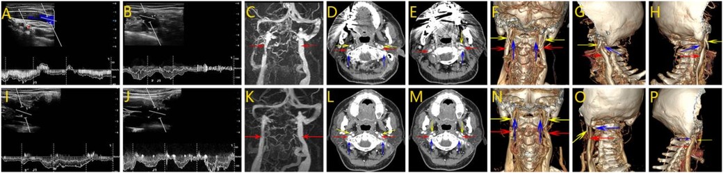 Medical imaging comparison of two cases shown in two rows. The top row (panels A-H) shows ultrasound, CT angiography, axial CT, and 3D reconstructions with marked areas in red, yellow, and blue. The bottom row (panels I-P) displays similar imaging techniques with corresponding areas highlighted, illustrating differences. Each panel is labeled with letters for reference.