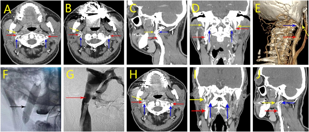 A series of medical images labeled A to J display various scan views. Arrows in different colors indicate specific areas: yellow, red, blue, and black. They highlight anatomical structures or areas of interest in cross-sectional, coronal, and sagittal CT scans and angiography, revealing details of the neck and cervical regions, likely for diagnostic evaluation.