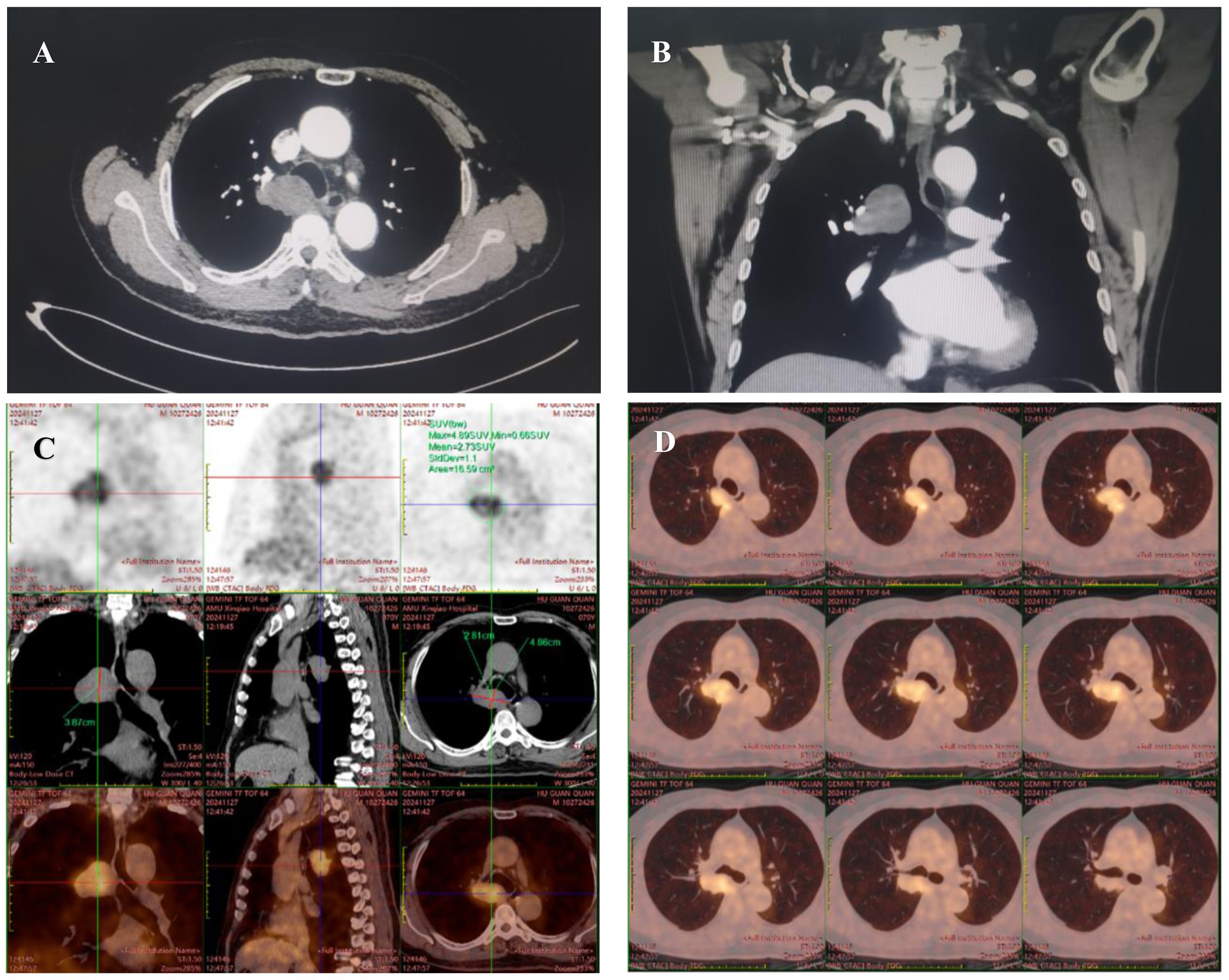 A set of medical scans showing different views of the chest. Image A: Cross-sectional CT scan. Image B: Coronal CT scan view. Image C: Multiple panel scans with measurements and PET/CT fusion images. Image D: Series of PET scans displaying metabolic activity in the lungs.