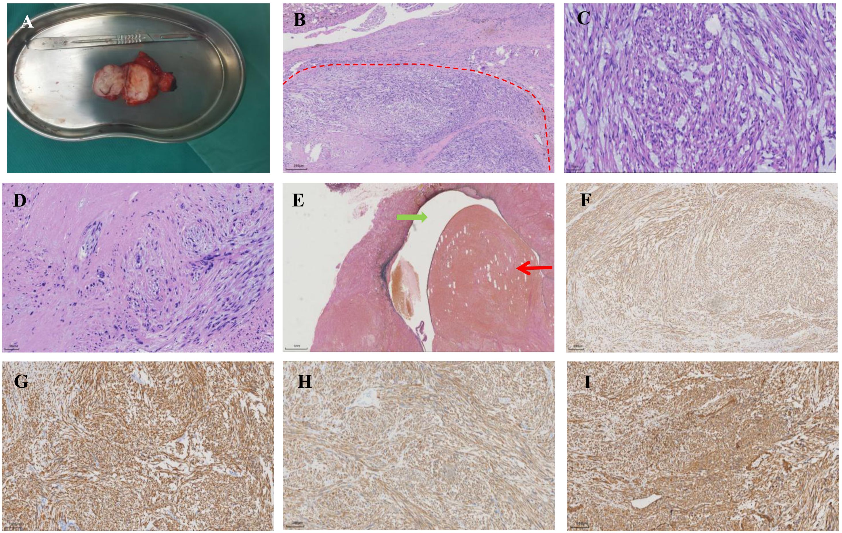 A surgical specimen on a metal tray labeled “A”. Microscopic images B to I show various tissue samples stained for histopathological examination. B highlights a distinct region with a red dashed line. C, D, and E display different tissue structures with E including green and red arrows pointing at specific areas. F, G, H, and I are stained samples showing cellular patterns and distribution.