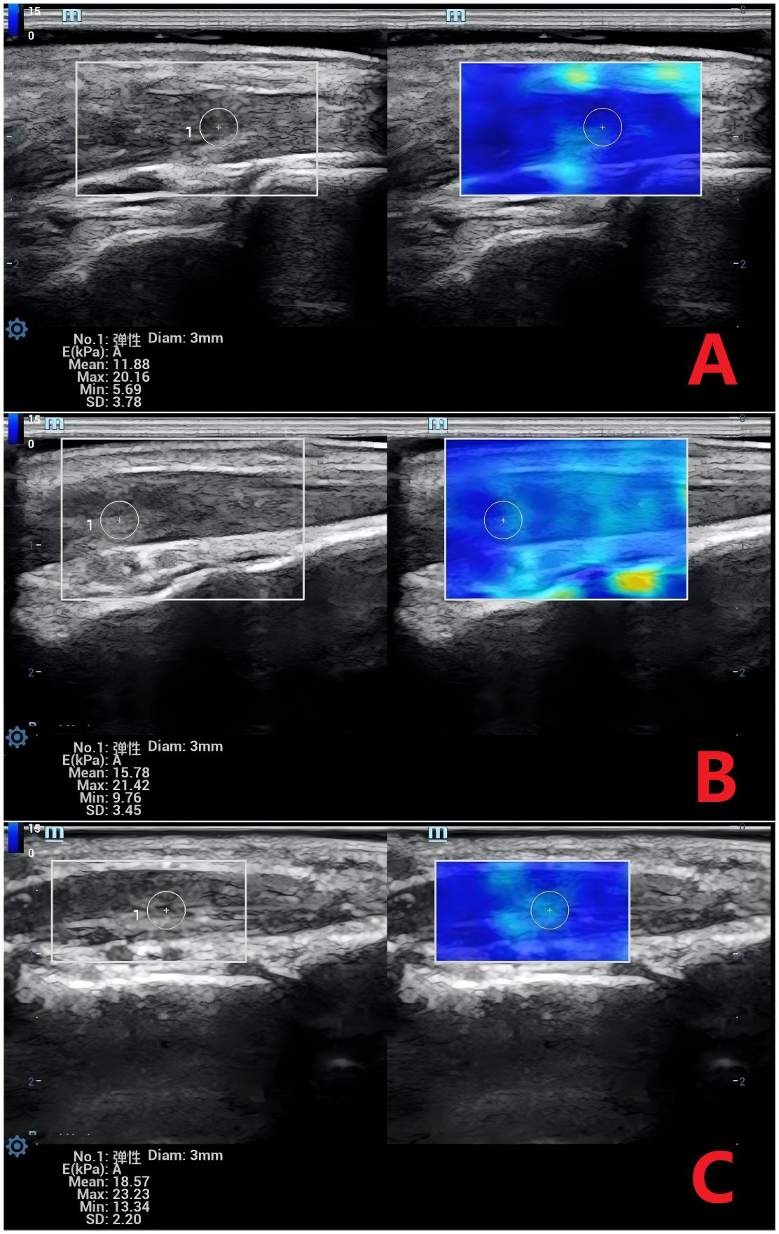 Three ultrasound images labeled A, B, and C, each showing a grayscale view alongside a color-coded elasticity map. Image A displays elasticity values with a mean of 11.88 kPa, Image B with a mean of 15.78 kPa, and Image C with a mean of 18.57 kPa. Each image includes a circled region of interest, with measurements of diameter, maximum and minimum values, and standard deviation. The elasticity maps feature shades of blue and occasional yellow areas.