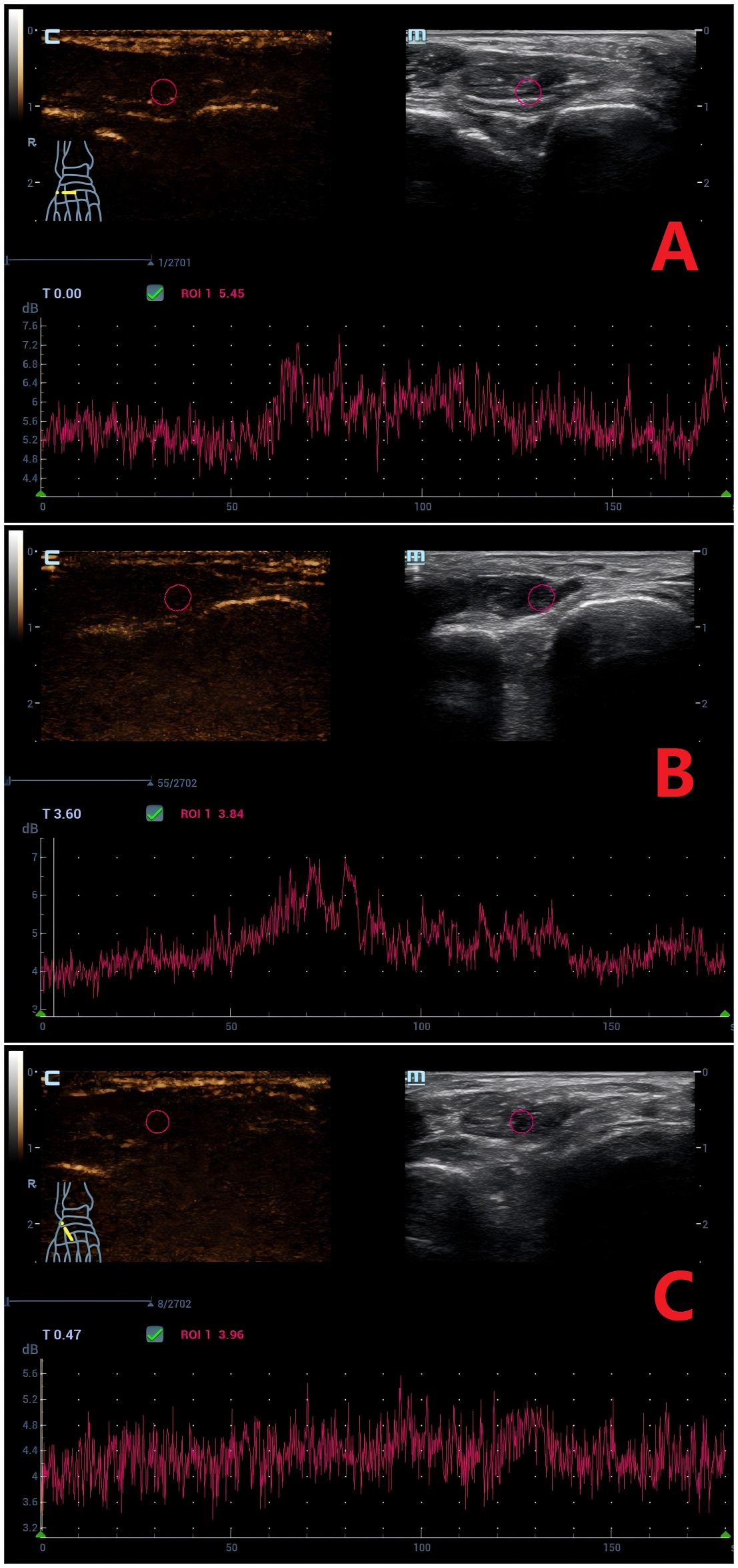 Three contrast-enhanced ultrasound (CEUS) time-intensity curves (TICs) labeled A, B, and C, showing perfusion dynamics in the extensor hallucis brevis muscle. Image A (Normal group): Arrival time (AT) = 50.5 s, peak intensity (PI) = 7.0 dB. Image B (DM group): AT = 51.6 s, PI = 6.7 dB. Image C (DM+MC group): AT = 89.5 s, PI = 5.0 dB. Regions of interest are marked in pink circles.