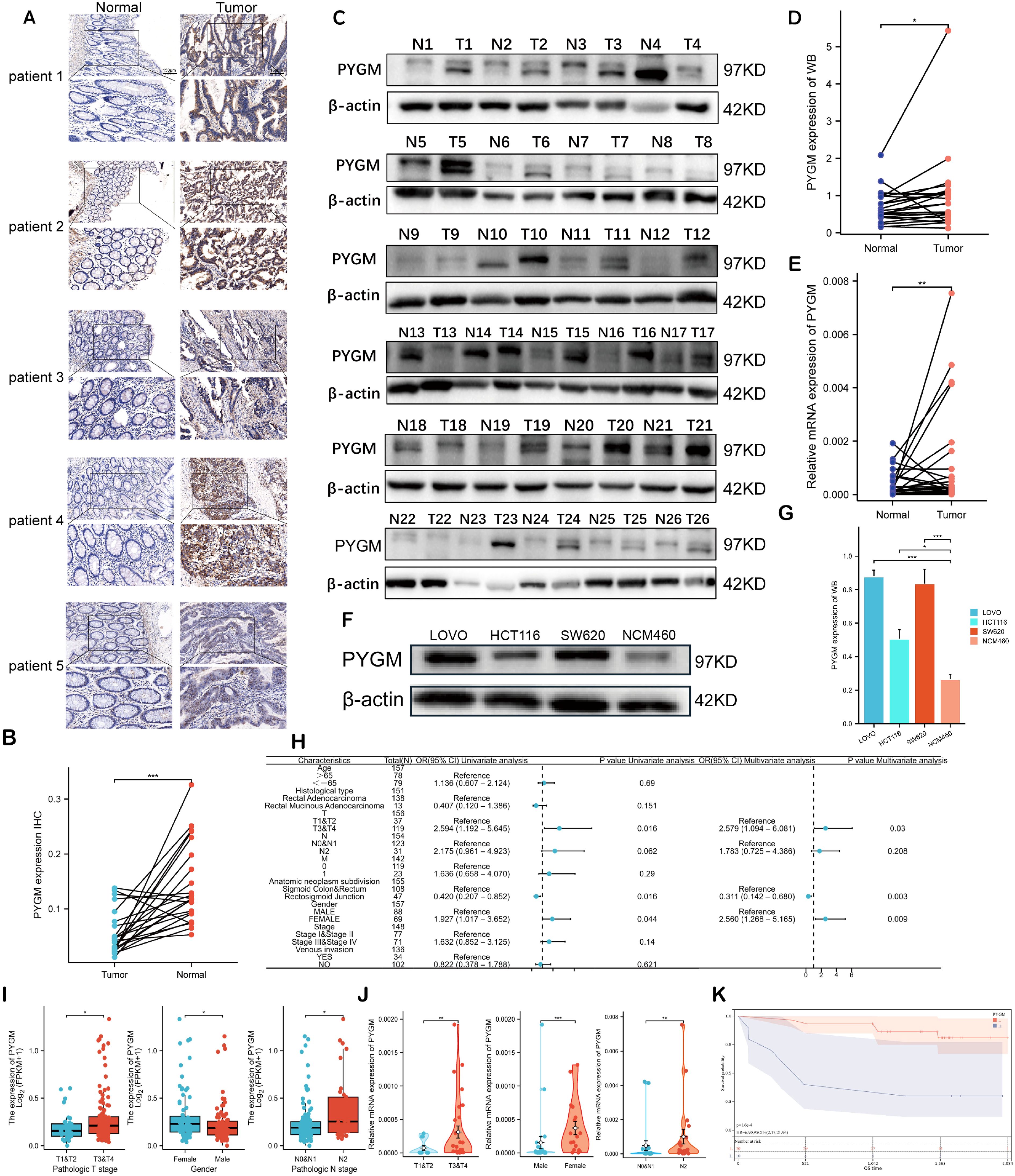 Various analyses of PYGM expression in normal and tumor tissues are shown. Panel A shows immunohistochemistry images from five patients, comparing normal and tumor tissues. Panel B shows a line graph of PYGM expression where lines represent individual patients. Panel C presents Western blots of PYGM and β-actin across different samples. Panels D and E display line graphs comparing normal and tumor PYGM expression. Panel F shows a Western blot for PYGM in different cell lines. Panel G is a bar graph of PYGM expression across cell lines. Panels I and J show box and violin plots of PYGM mRNA levels, and panel K displays a survival curve.