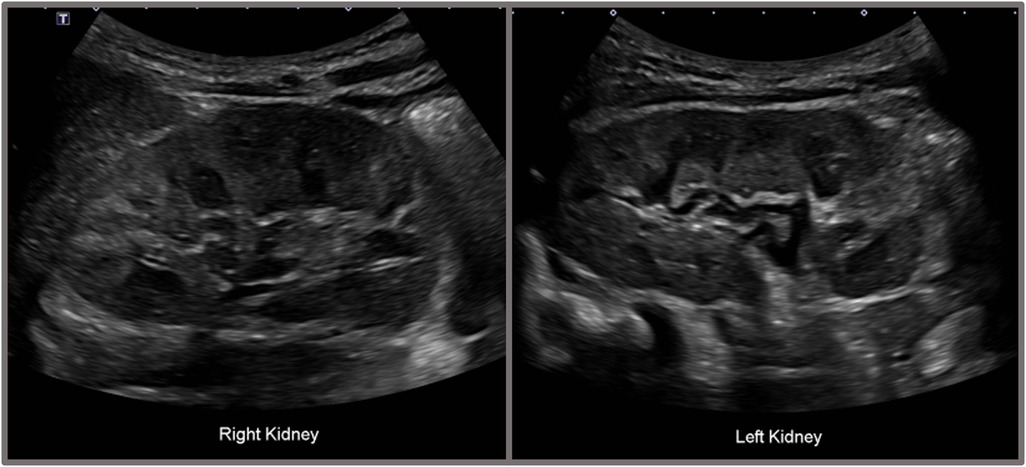 Ultrasound images of the kidneys. The left panel shows the right kidney, and the right panel shows the left kidney. Both images display typical ultrasound features used for medical assessment.