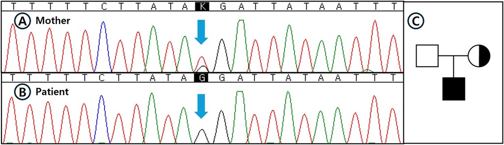 Two genetic sequences are shown with chromatograms for a mother (A) and patient (B), highlighting a nucleotide change from K to G. An arrow indicates the specific alteration. Panel C depicts a pedigree chart showing the inheritance pattern, with a half-filled symbol for one parent and a filled symbol for the patient.