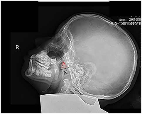 X-ray side profile of a child nasopharyngeal showing nasopharyngeal and anatomy. The image has a nnotated lines labeled \