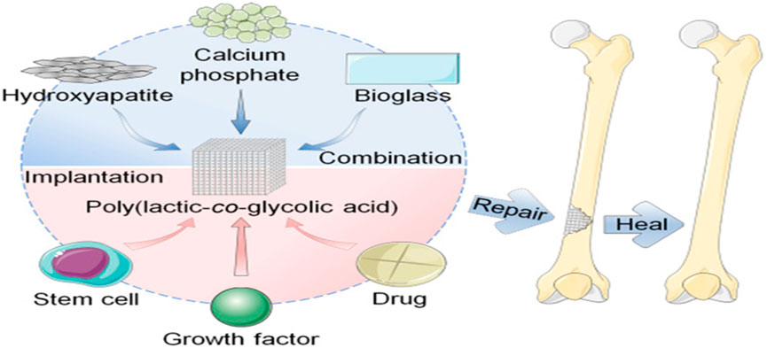 Diagram showing components for bone repair. Calcium phosphate, hydroxyapatite, and bioglass are combined with poly(lactic-co-glycolic acid) for implantation. Stem cells, growth factors, and drugs also contribute.