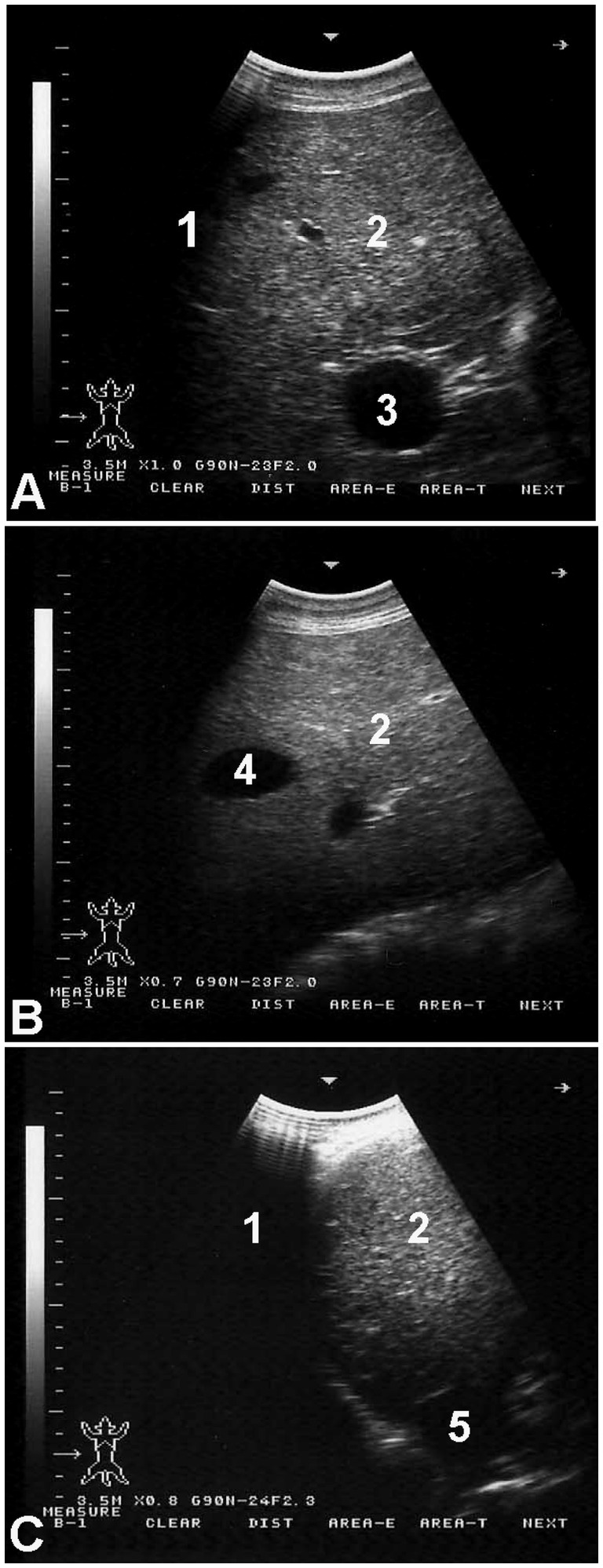 Three ultrasound images labeled A, B, and C show different sections, possibly abdominal. Image A shows markers 1, 2, and 3; B shows markers 2 and 4; C shows markers 1, 2, and 5. Each image displays organ structures with varying textures and densities.