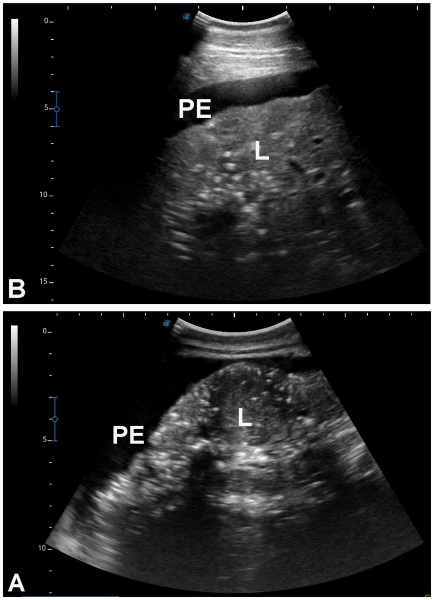 Two ultrasound images labeled A and B show a lung (L) with pleural effusion (PE). In both images, a fluid-filled area (PE) appears above the lung tissue (L), indicating the presence of effusion. The grayscale bar on the side provides a reference for depth measurement.