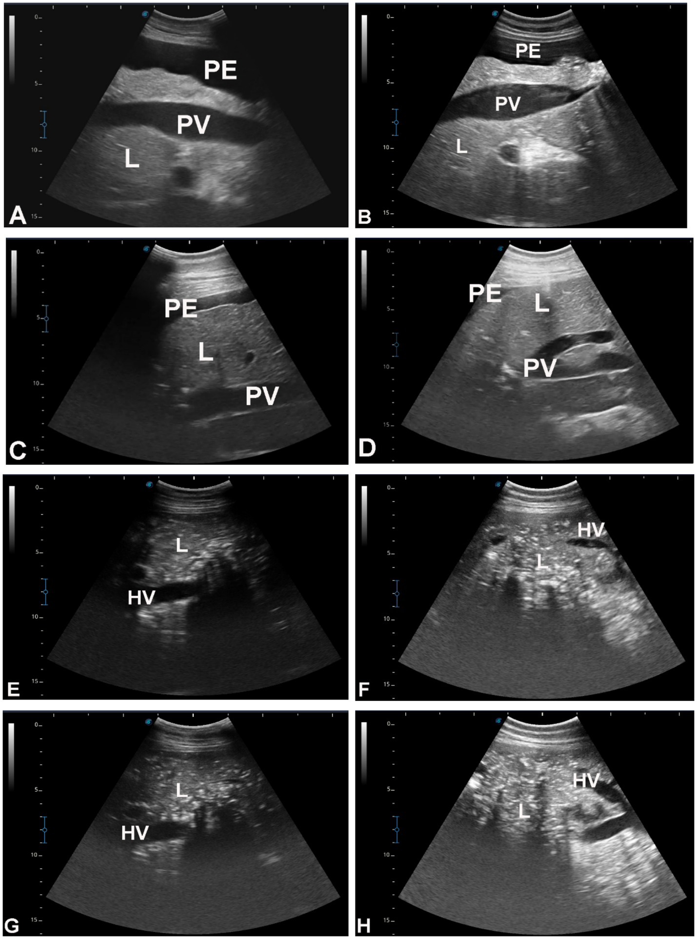 Ultrasound images labeled A to H show different liver sections with annotations. Panels A to D highlight regions labeled PE (pleural effusion), PV (portal vein), and L (liver). Panels E to H display liver sections marked with L (liver) and HV (hepatic vein), illustrating various views and structures.