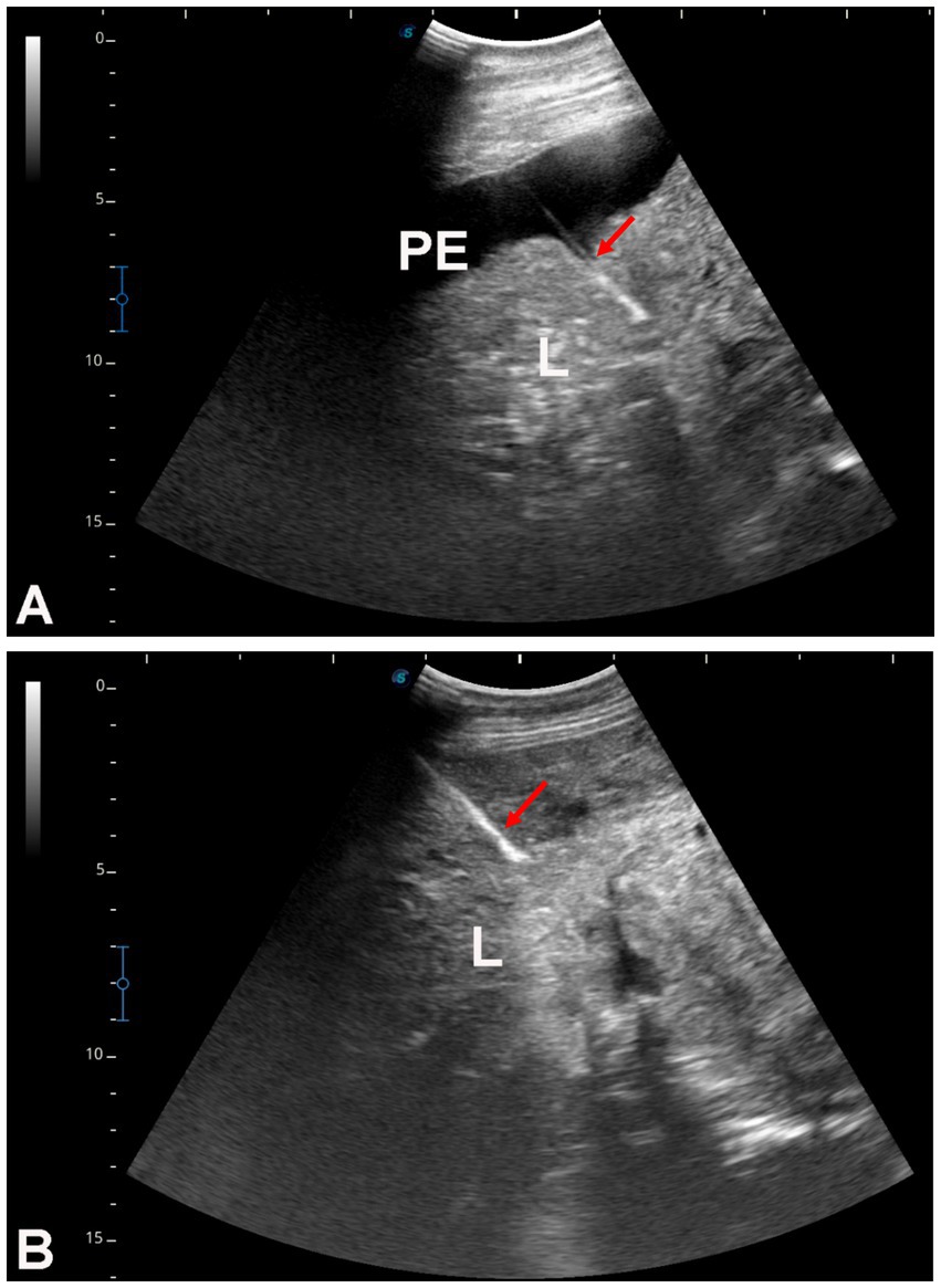 Ultrasound images labeled A and B show the liver (L) and pleural effusion (PE). Red arrows point to areas of interest near the liver, indicating possible changes or abnormalities. Grayscale scales and measurement markers are visible on the sides.