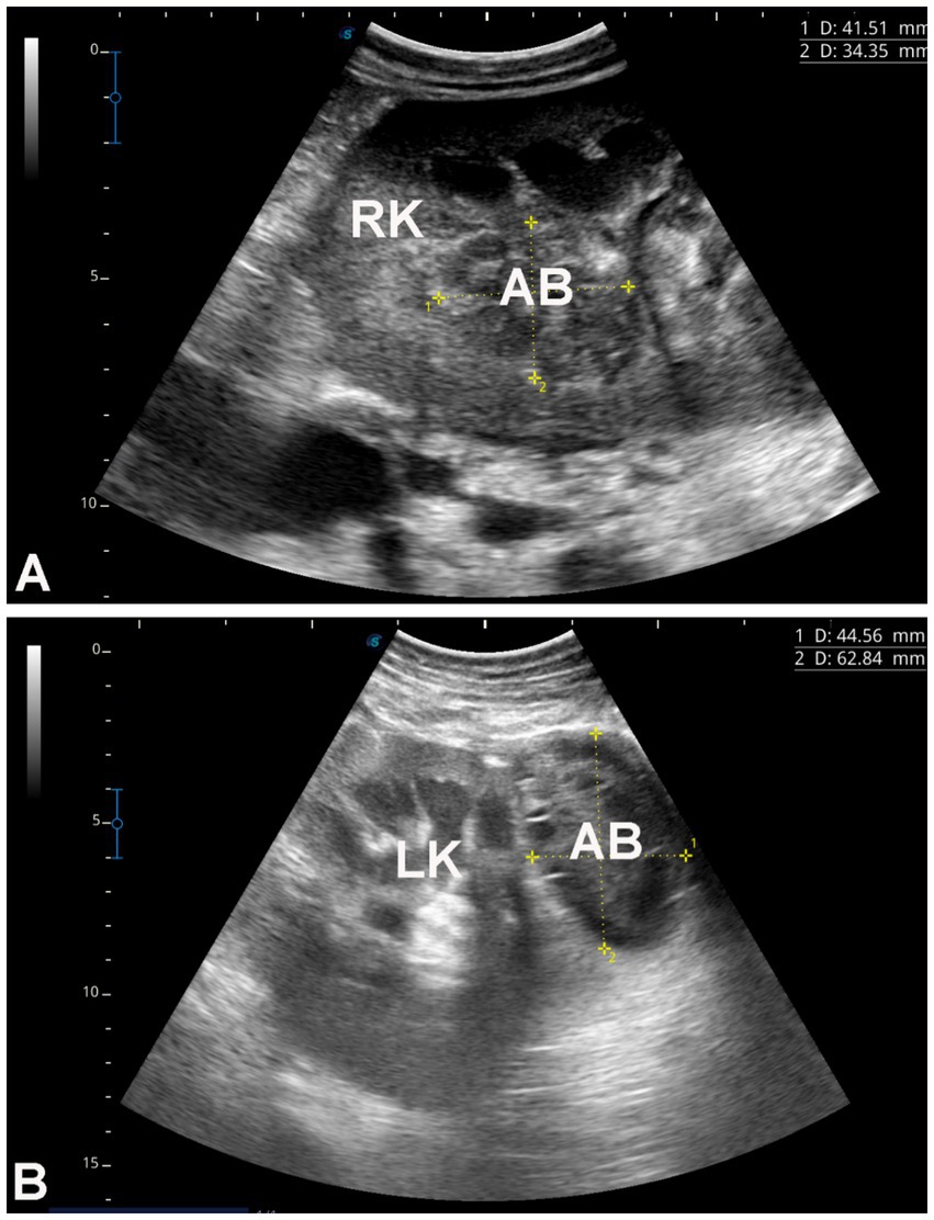 Ultrasound image showing two panels labeled A and B. Panel A displays the right kidney (RK) and the abdominal area (AB) with annotated measurements of 41.51 mm and 34.35 mm. Panel B shows the left kidney (LK) and the abdominal area with measurements of 44.56 mm and 62.84 mm.