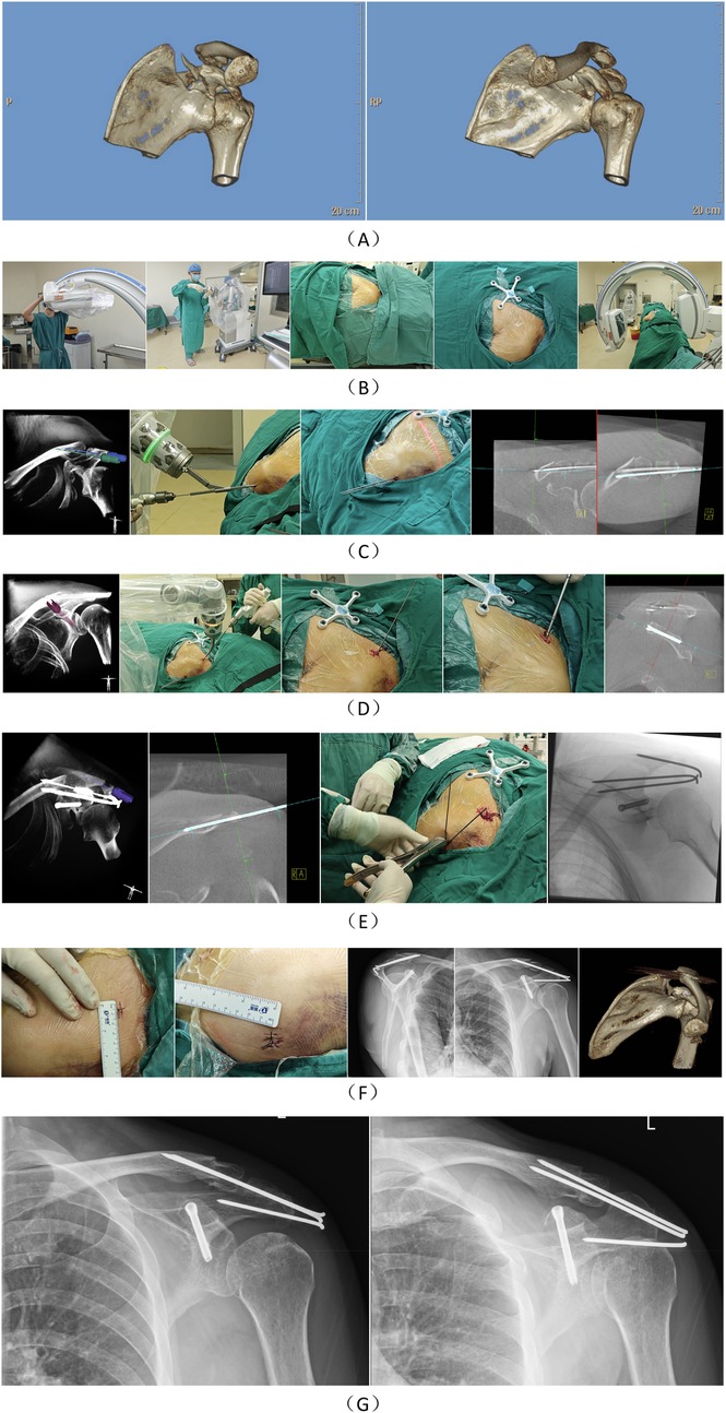 A series of medical images depicting various stages of a shoulder surgical procedure. Panel A shows 3D scans of a shoulder bone. Panel B includes images of a surgical setup and patient prep. Panel C focuses on instrument alignment and patient positioning. Panel D highlights the insertion of surgical tools during the procedure. Panel E demonstrates further insertion and adjustment of medical instruments. Panel F shows measurements and X-rays of the surgical area. Panel G displays X-rays post-operation indicating fixation and alignment of surgical implants. All images are labeled alphabetically to show the sequence.