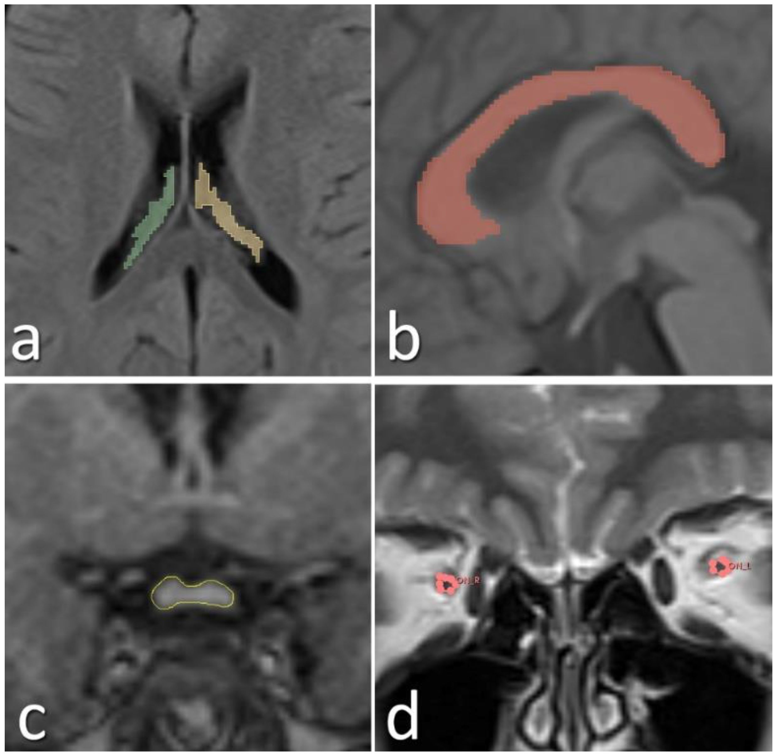Four MRI brain scans labeled a, b, c, and d. Image a shows colored regions in the corpus callosum. Image b highlights the corpus callosum in red. Image c outlines a central structure in yellow. Image d marks the optic nerves in red with “OLR” and “OLL”.