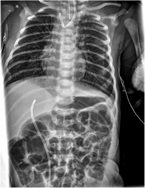 X-ray of a human thorax and abdomen displaying the ribs, spine, and internal organs. A proximally flipped orogastric tube is visible, suggesting a clinical setting. The image is focused on the upper body, showing clear skeletal and organ outlines. The abdominal gas distribution is regular.