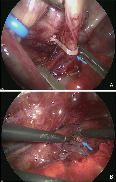 Two thoracoscopic images showing surgical procedures. The first image displays a blue arrow pointing to a polymer clip securing tissue (TEF). The second image shows a blue arrow indicating the closed clip on the separated fistula between surgical instruments labeled