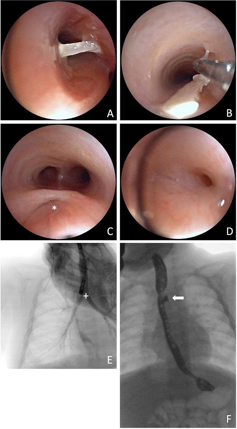 Endoscopic images showing various perspectives of the trachea. Thoracic x-rays showing contrast medium in the esophagus and bronchial system. The top row features endoscopic views of a foreign object in the airway, with an extraction tool in one image. The middle row shows a close-up of the airway with a small ostium. The bottom row contains X-ray images displaying the esophageal tract, marked by symbols indicating specific areas of focus.