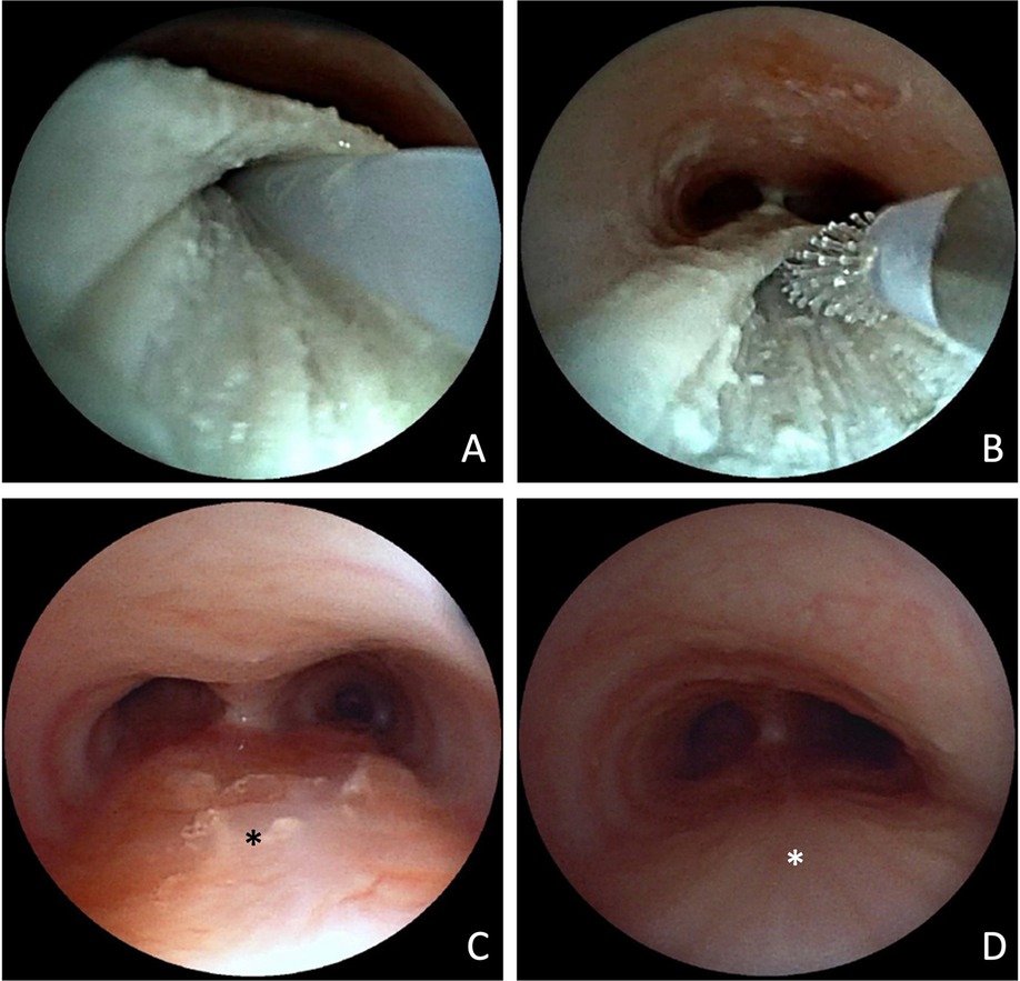 Four circular images showing an endoscopic procedure in the trachea. Top left: a tool in whitish debrided tissue. Top right: a brush in whitish debrided tissue. Bottom left: scarred tissue in the trachea marked with an asterisk. Bottom right: healed tracheal tissue marked with an asterisk.
