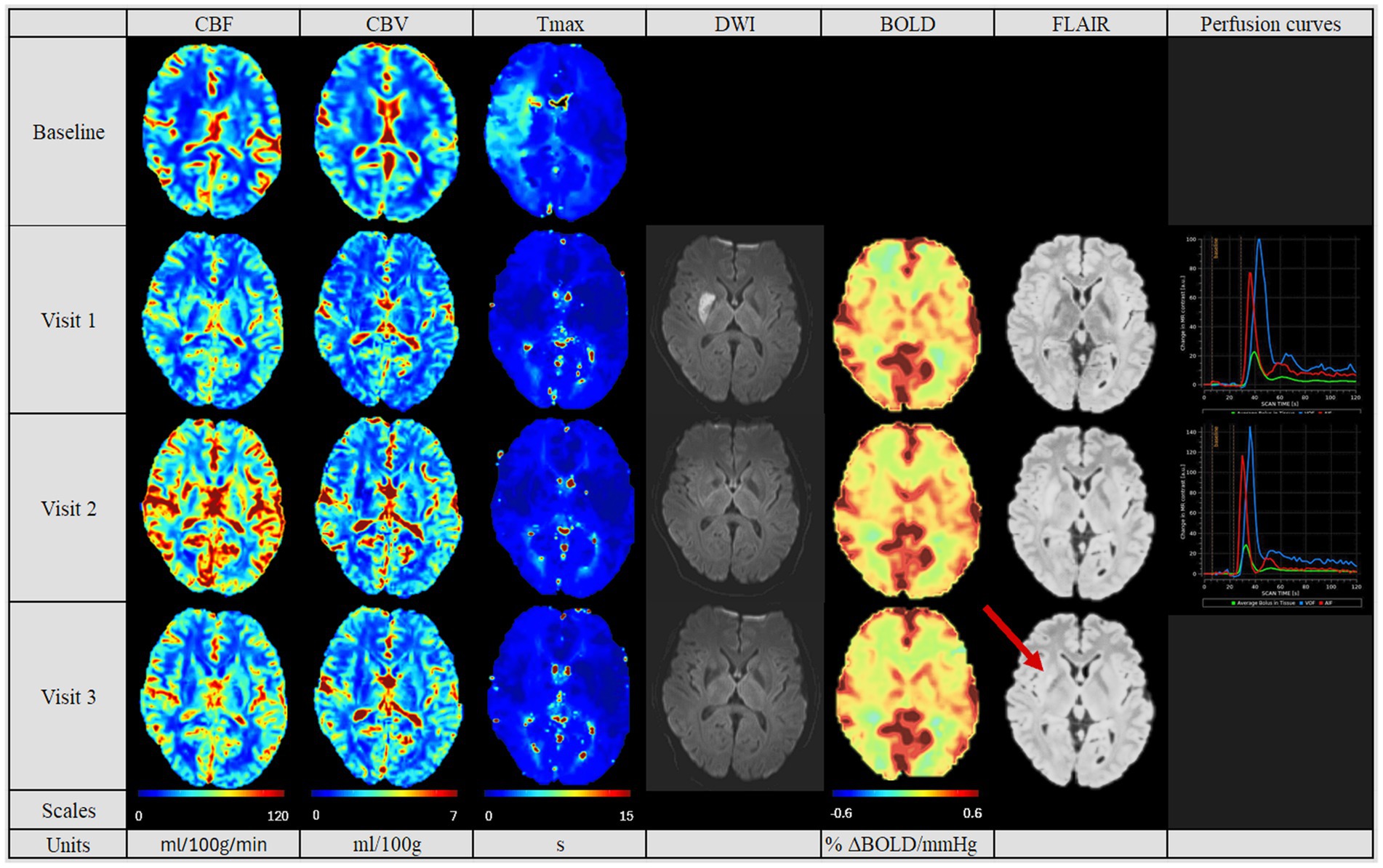 Colored brain imaging scans showing different metrics: Cerebral Blood Flow (CBF), Cerebral Blood Volume (CBV), Tmax, Diffusion-Weighted Imaging (DWI), Blood Oxygen Level-Dependent (BOLD), and Fluid-Attenuated Inversion Recovery (FLAIR). Rows represent baseline and three visits. Each set includes perfusion curves. Color scales and units are indicated below each metric.