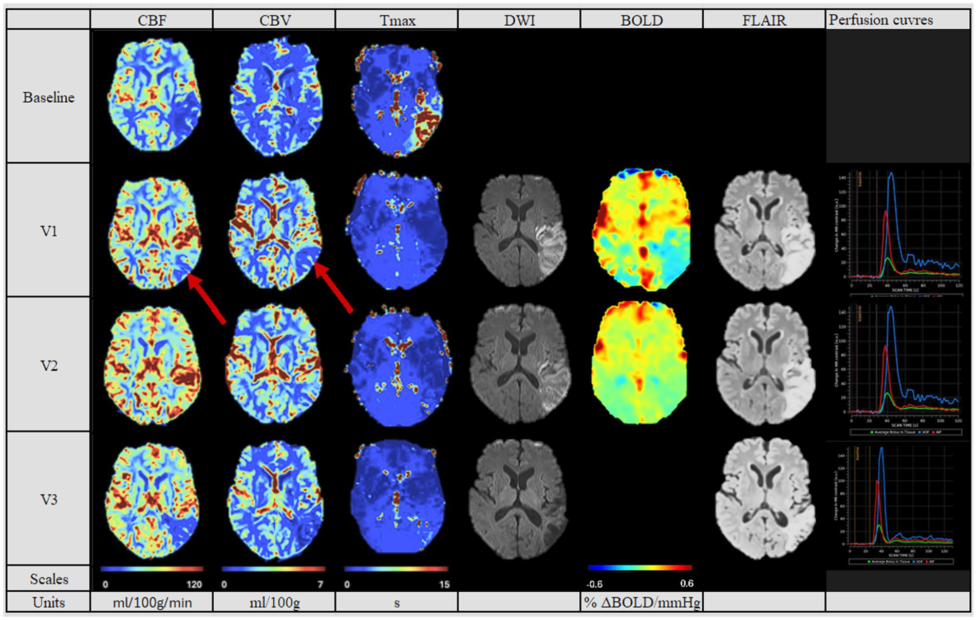 Brain imaging scans comparing different modalities: CBF, CBV, Tmax, DWI, BOLD, and FLAIR, across three stages: Baseline, V1, V2, and V3. The images show color variations indicating different measurements, with arrows pointing to specific areas in CBF and CBV images at V1. Perfusion curves are displayed on the right, showing scan time data for each stage. Scales and units are provided at the bottom.
