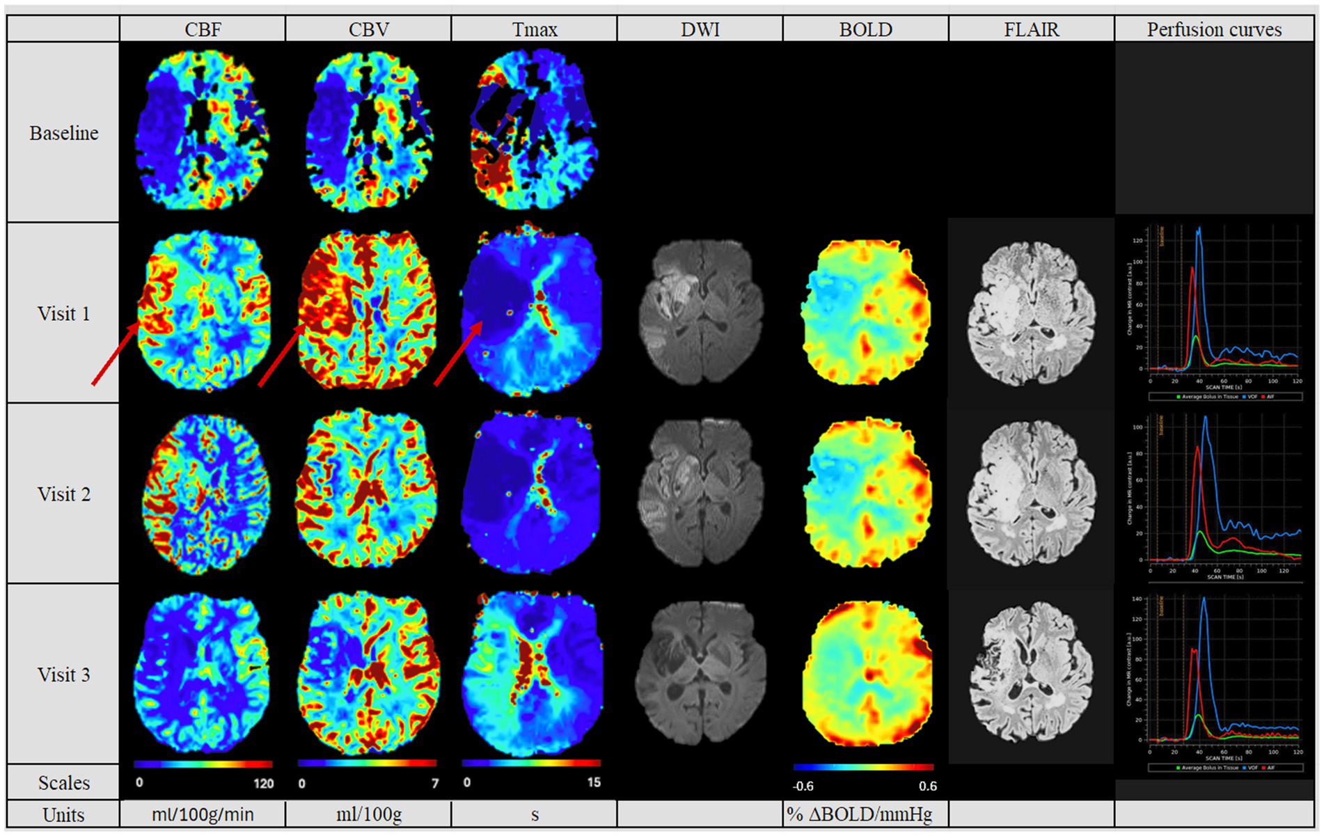 Medical imaging panel showing brain scans across four visits, labeled Baseline, Visit 1, Visit 2, and Visit 3. Each row displays images in columns for CBF, CBV, Tmax, DWI, BOLD, FLAIR, and perfusion curves. Scales and units are provided at the bottom. Arrows highlight differences in certain areas during Visit 1. Perfusion curves depict graphs with peaks in flow rates.