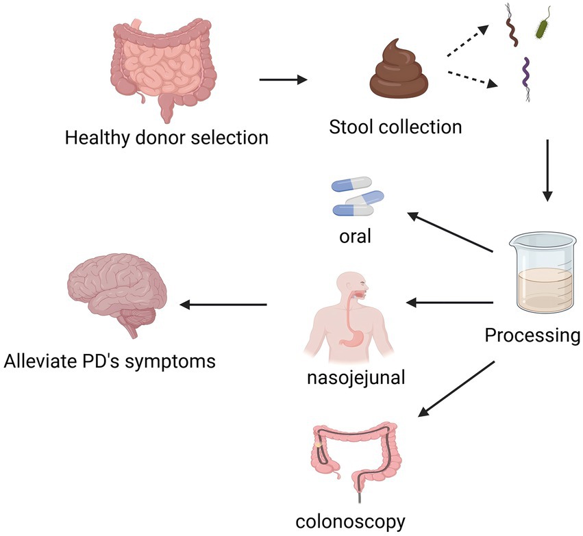 Flowchart illustrating a process starting with healthy donor stool selection. The stool is collected and processed. It can then be administered orally, via nasojejunal tube, or colonoscopy. The aim is to alleviate Parkinson's disease symptoms, represented by an arrow pointing to a brain.