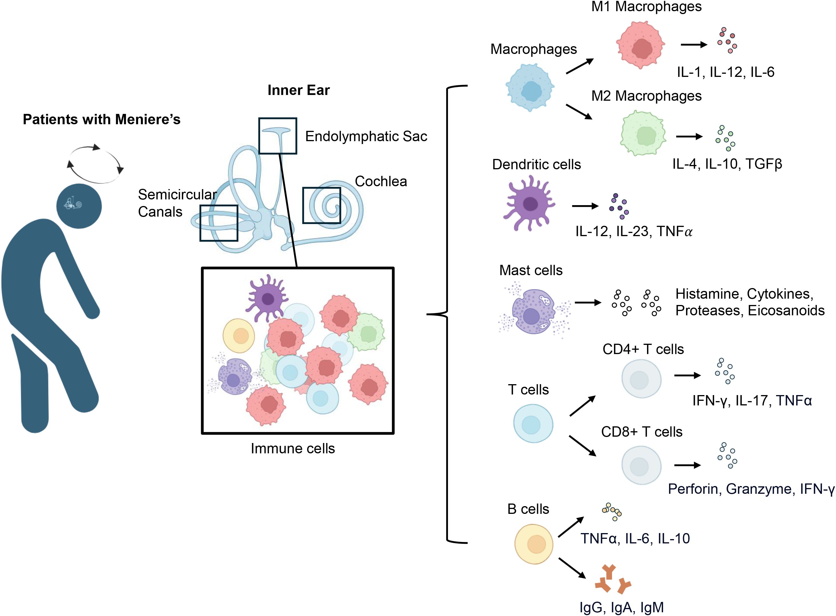 Diagram illustrating immune cell involvement in Meniere's disease. It shows the inner ear's endolymphatic sac, cochlea, and semicircular canals, highlighting immune cells like macrophages, dendritic cells, mast cells, T cells, and B cells. Each cell type produces specific cytokines, such as IL-1 and IL-12 from M1 macrophages, IL-4 from M2 macrophages, and IgG from B cells. It represents the potential pathophysiological mechanism in patients with Meniere’s disease.