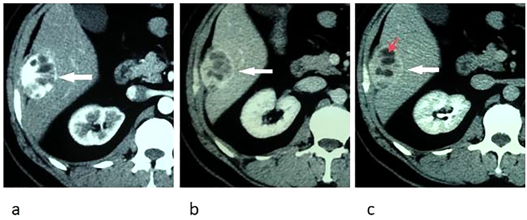 CT images of different enhanced-phases of the liver lession, with unenhanced intratumoral cystic areas (red arrow) and enhanced capsule (white arrow).
