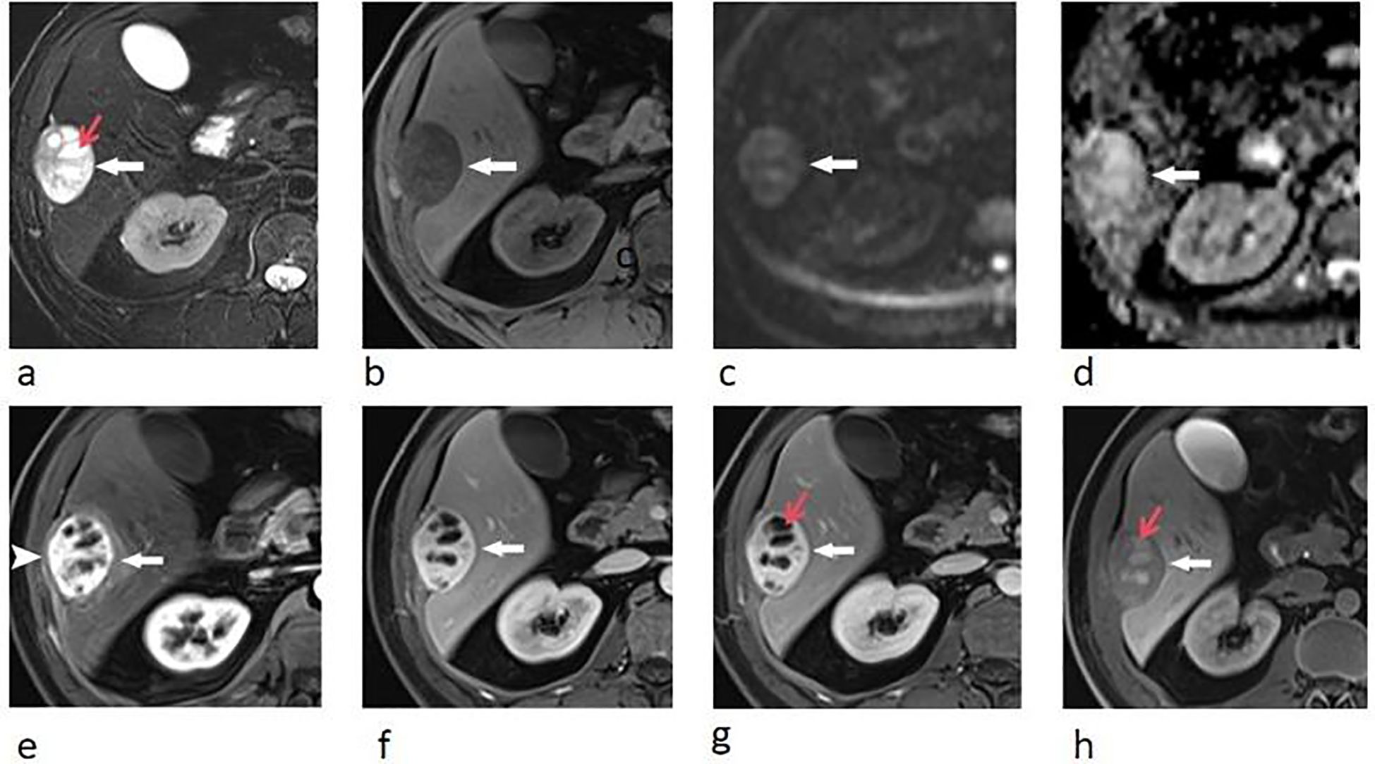 MRI scans showing different perspectives of the abdominal area. All images are labeled (a) to (h). Arrows point to areas of interest, possibly indicative of abnormalities. The red arrows highlight a particular spot in images (a), (g), and (h), while white arrows in other images indicate additional points of note.