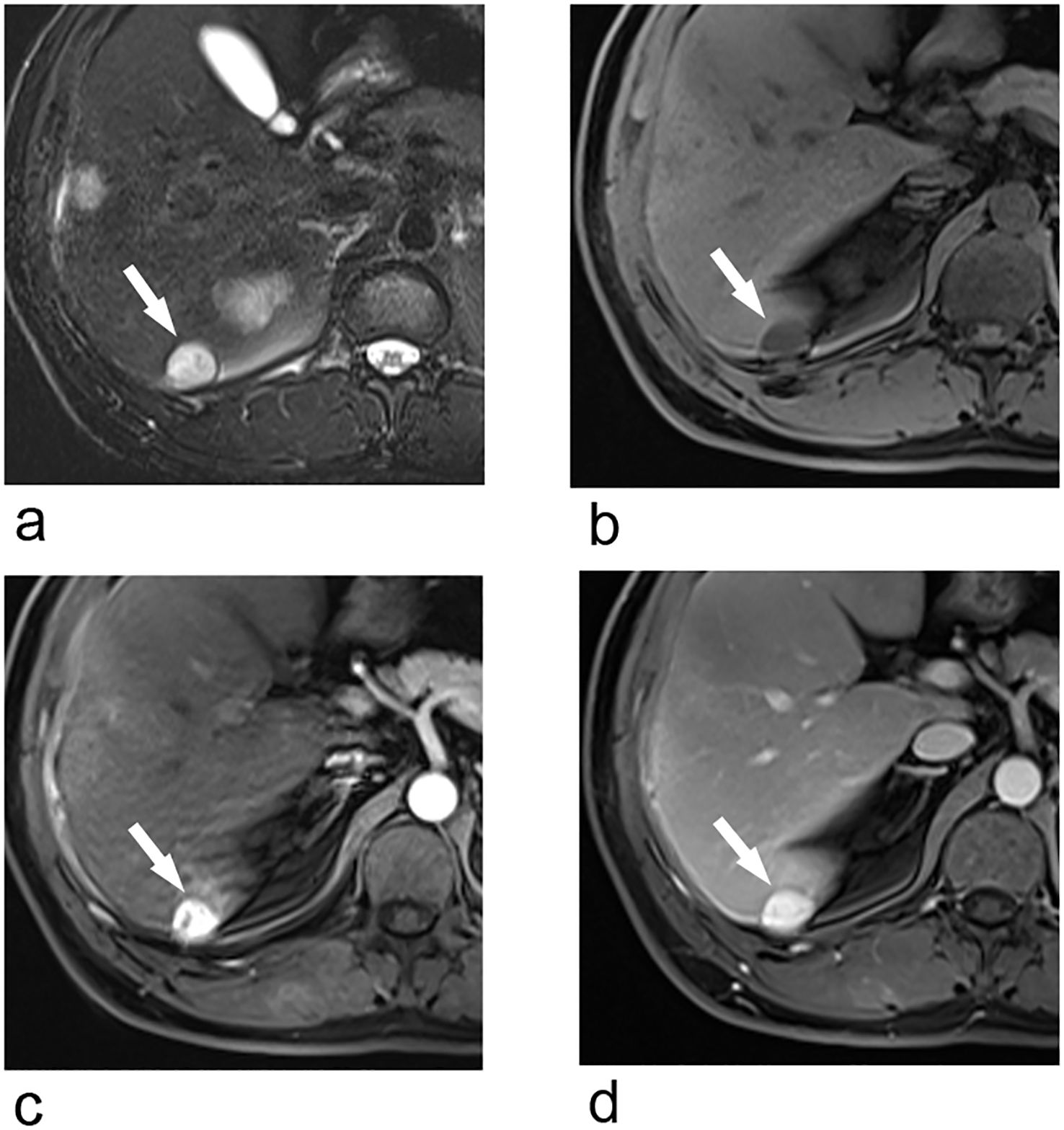Four MRI images labeled a, b, c, and d. Each image shows a liver lesion highlighted by a white arrow. The lesions are located in the liver's lower region, appearing as bright spots against the darker background.