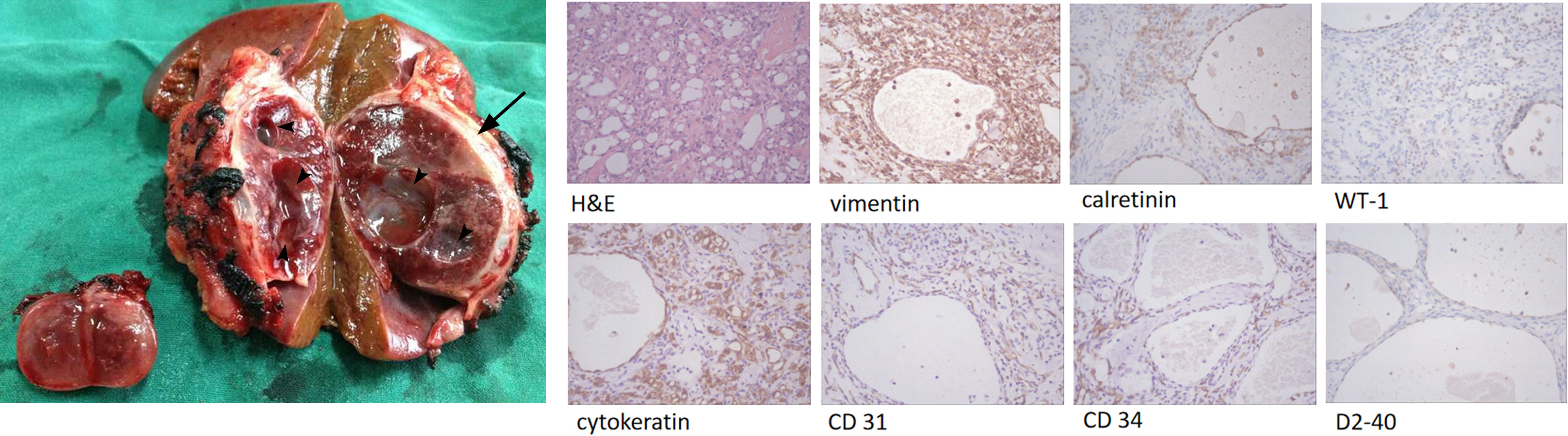 A collage showing a dissected organ on the left, revealing internal structure and abnormalities, with a series of six microscopic tissue images on the right. The images show tissue stained for different markers: H&E, vimentin, calretinin, WT-1, cytokeratin, CD 31, CD 34, and D2-40, highlighting variations in staining patterns across the samples.