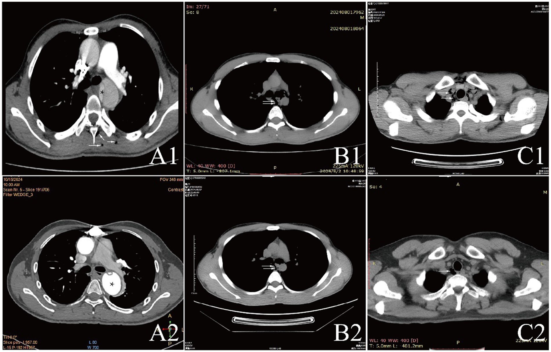 Six-panel CT scan images labeled A1, A2, B1, B2, C1, and C2. Panels A1 and A2 appear to show the chest area with certain regions marked. Panels B1 and B2 show similar chest images with arrows pointing to specific areas. Panels C1 and C2 focus on the upper chest, displaying bone and tissue contrast. Each scan shows different cross-sectional views and includes technical details and settings.