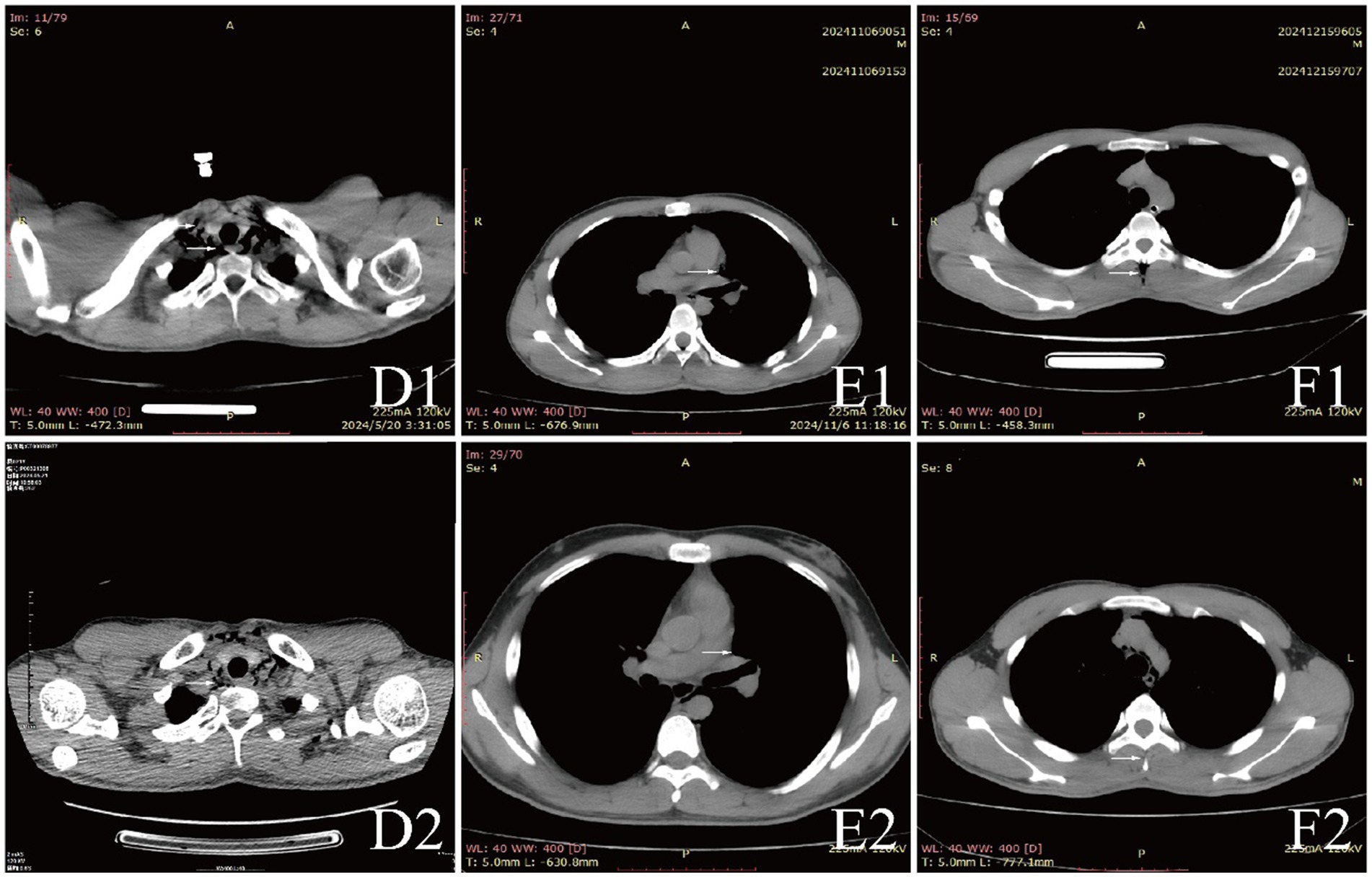 CT scan images in a 3x2 grid, labeled D1, E1, F1 (top row) and D2, E2, F2 (bottom row). Each scan presents axial views of the upper chest, highlighting different anatomical structures with varying levels of density.