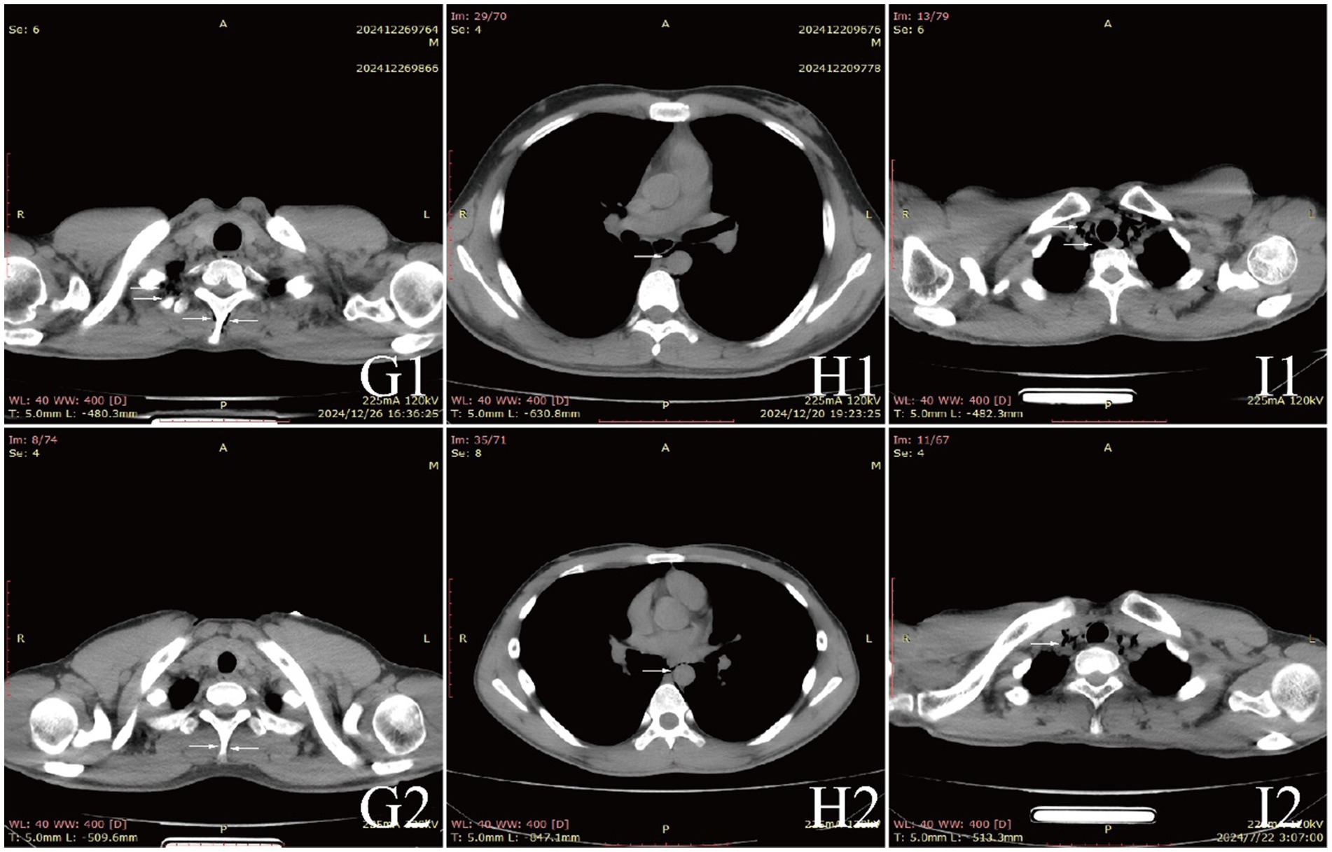 Six-panel CT scan images of a thoracic region, labeled G1, G2, H1, H2, I1, and I2. Each panel shows different cross-sectional views, with white and gray areas depicting various tissues and structures. Labels and settings are visible along the edges.