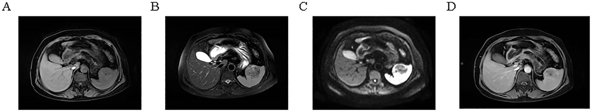 MRI scans labeled A, B, C, and D show axial views of the abdomen. Each scan presents different contrasts and highlights regions with varying signal intensities, potentially indicating different tissues or conditions.