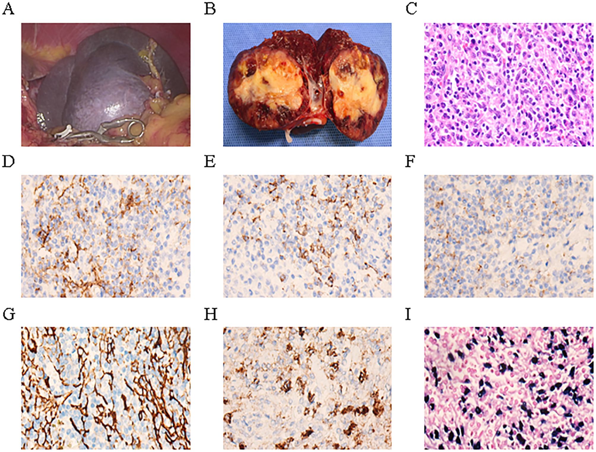 Panel A shows a surgical view of liver disease. Panel B displays a liver specimen with tumors. Panel C is a histological section with dense cells stained in pink and purple. Panels D to H are immunohistochemical images showing varying brown staining patterns on a blue cellular background. Panel I is a pink and purple stained histological section with dense cellular patterns.