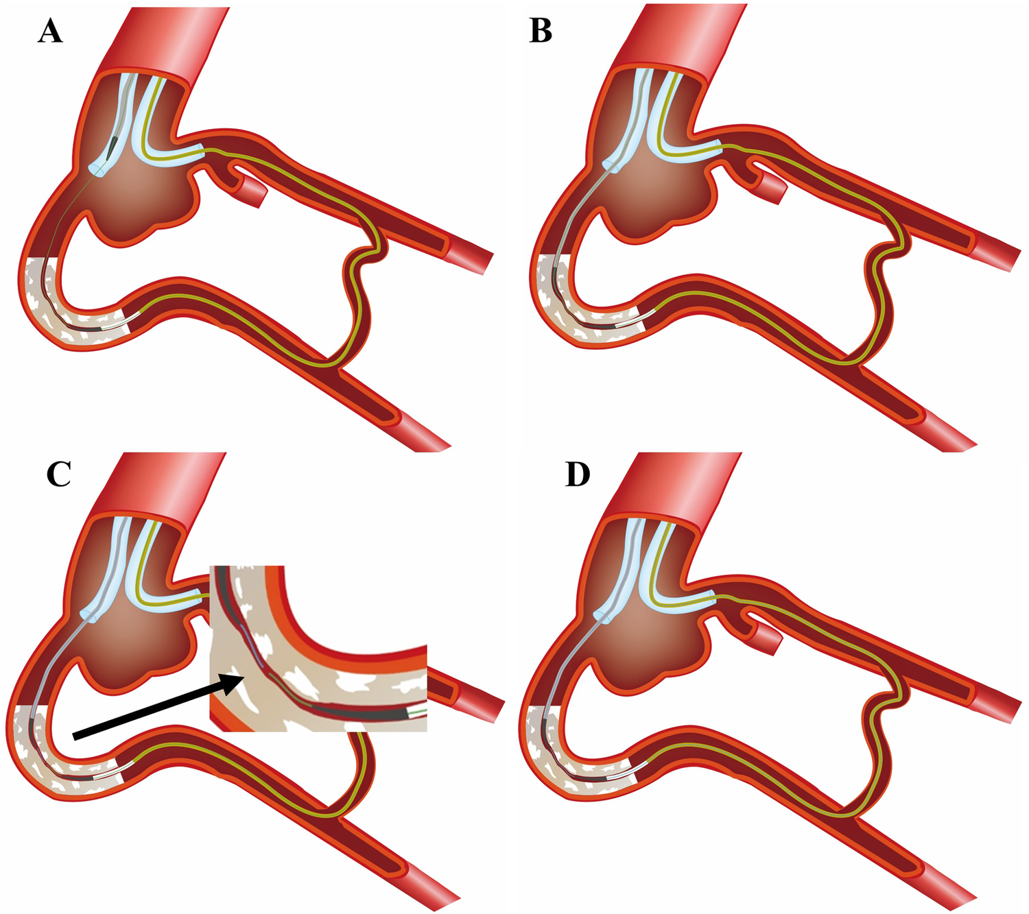 Illustration showing cross-sections of the human stomach and intestines in different stages or conditions labeled A, B, C, and D. Each section highlights various details of the gastrointestinal tract, including the layers of tissue and pathways, with section C featuring a close-up detail emphasized by an arrow.