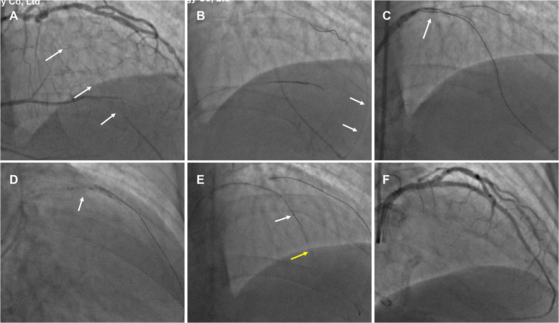 Six-panel medical image showing angiographic sequences labeled A to F. Each panel depicts different stages and views of coronary arteries. Arrows indicate specific areas of focus within the coronary structure. Panels vary in highlighting different pathways and flow dynamics, essential for understanding the blood supply and possible obstructions.