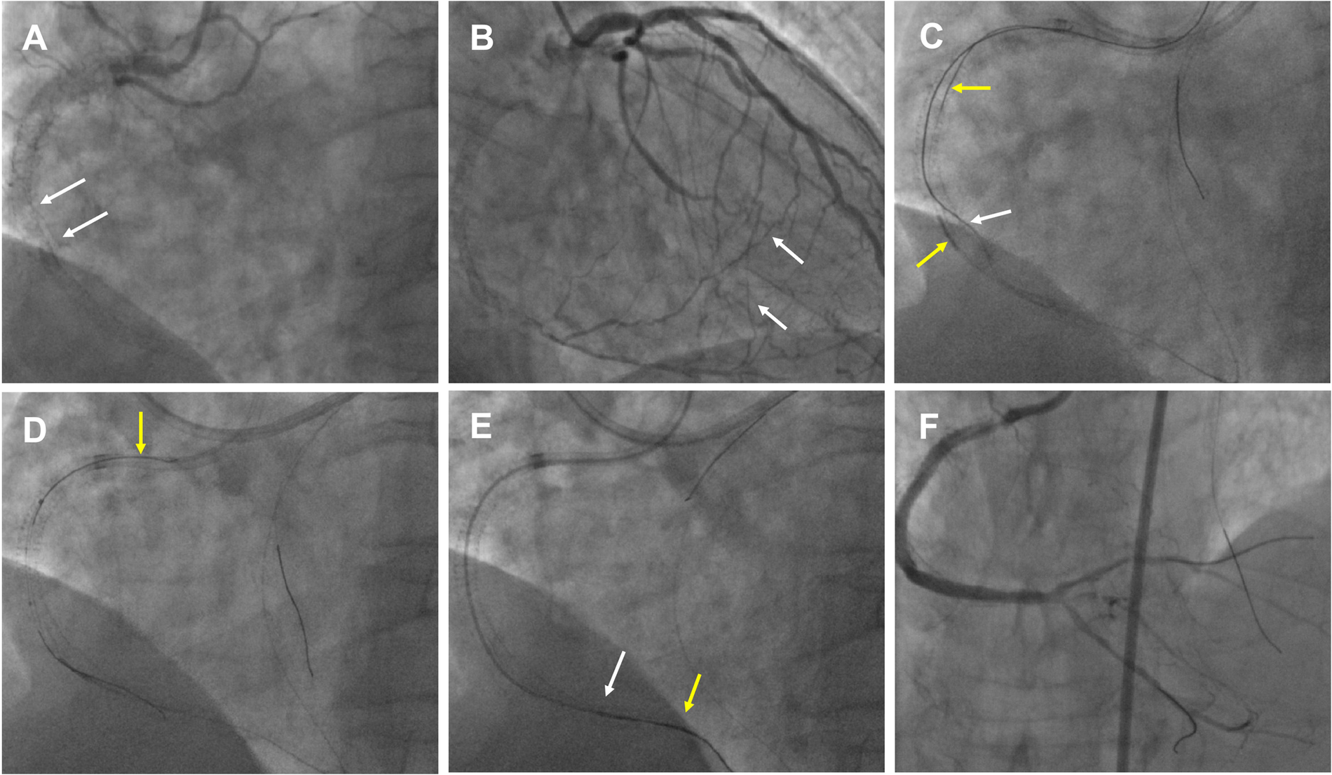 Six-panel angiogram showing coronary arteries with some areas indicated by arrows. Panel A shows two white arrows pointing to a section of the artery. Panel B has two white arrows indicating another area. Panel C displays one white and two yellow arrows marking specific spots. Panel D includes a single yellow arrow pointing to part of the artery. In Panel E, there is one white and one yellow arrow highlighting specific sections. Panel F shows a clear view of the artery without any arrows.