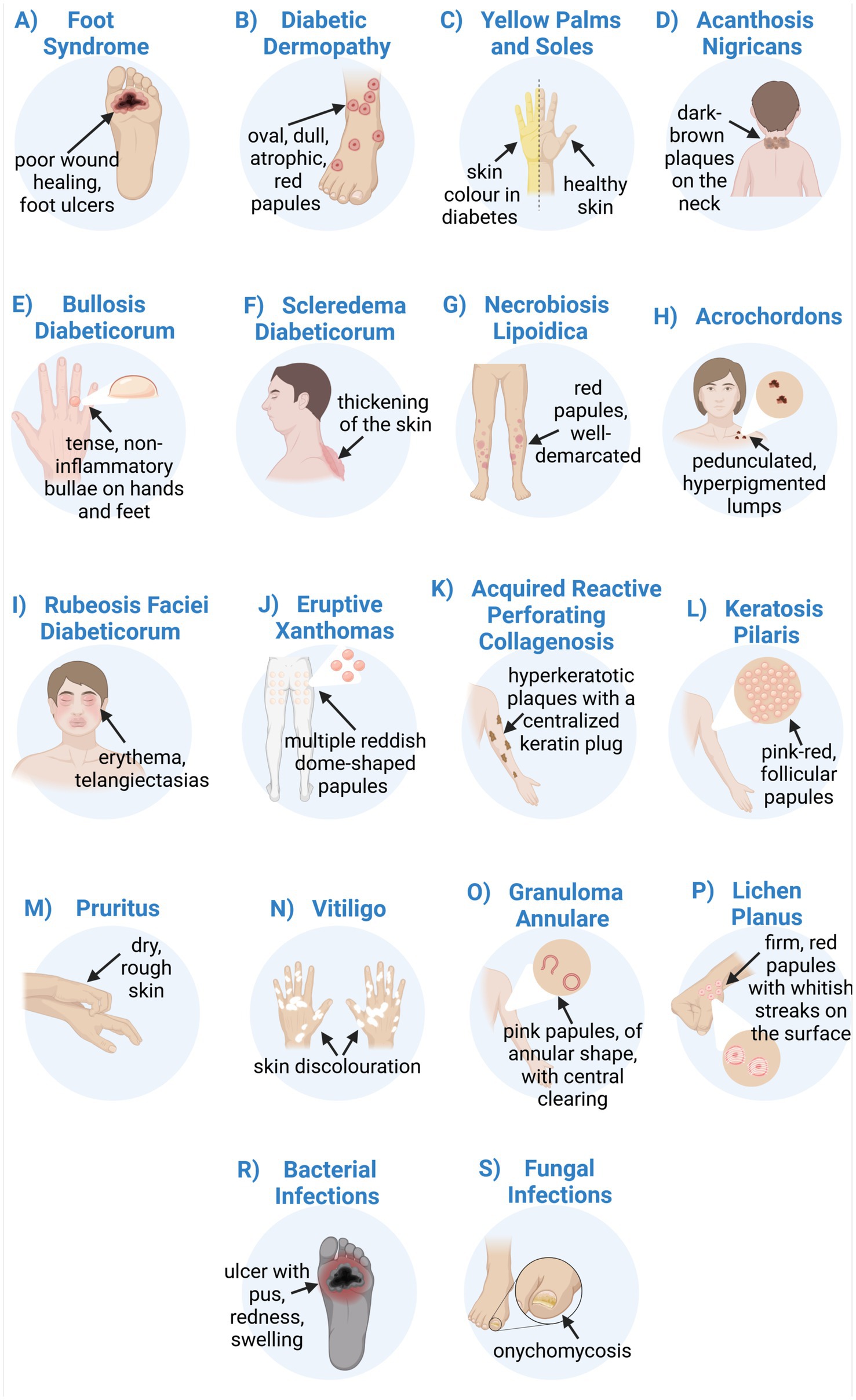 Medical illustration showing various skin conditions associated with diabetes. Conditions include foot syndrome, diabetic dermopathy, yellow palms and soles, acanthosis nigricans, bullosis diabeticorum, sclerederma diabeticorum, necrobiosis lipoidica, acrochordons, rubeosis faciei diabeticorum, eruptive xanthomas, acquired reactive perforating collagenosis, keratosis pilaris, pruritus, vitiligo, granuloma annulare, lichen planus, bacterial infections, and fungal infections. Each condition is illustrated with labels describing key features such as poor wound healing, red papules, skin thickening, and hyperpigmented lumps.